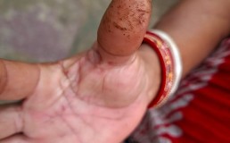 Photo of a workers thumb showing her skin worn away. Creit: Rejimon Kuttappan